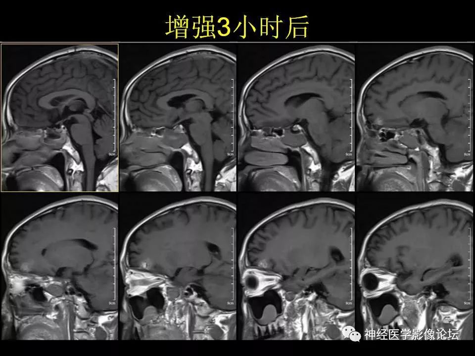 【病例】右额叶脑挫裂伤一例MR及CT