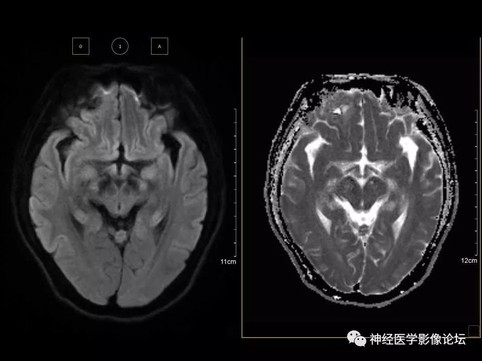 【病例】右额叶脑挫裂伤一例MR及CT