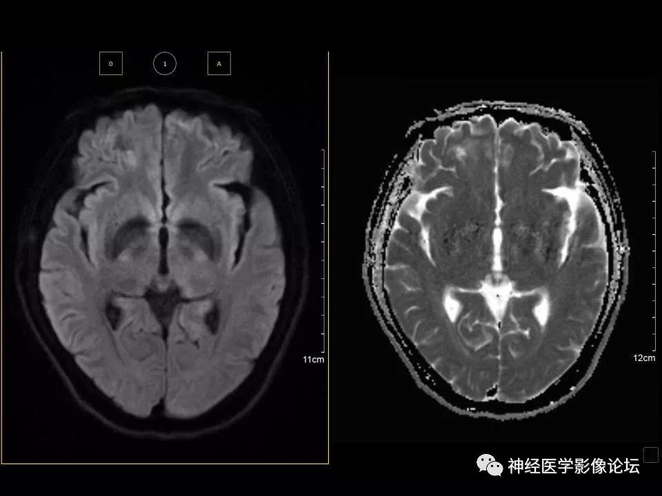 【病例】右额叶脑挫裂伤一例MR及CT
