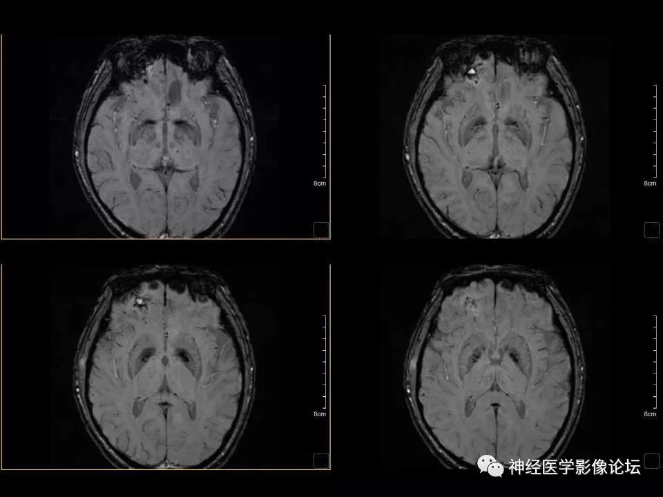 【病例】右额叶脑挫裂伤一例MR及CT