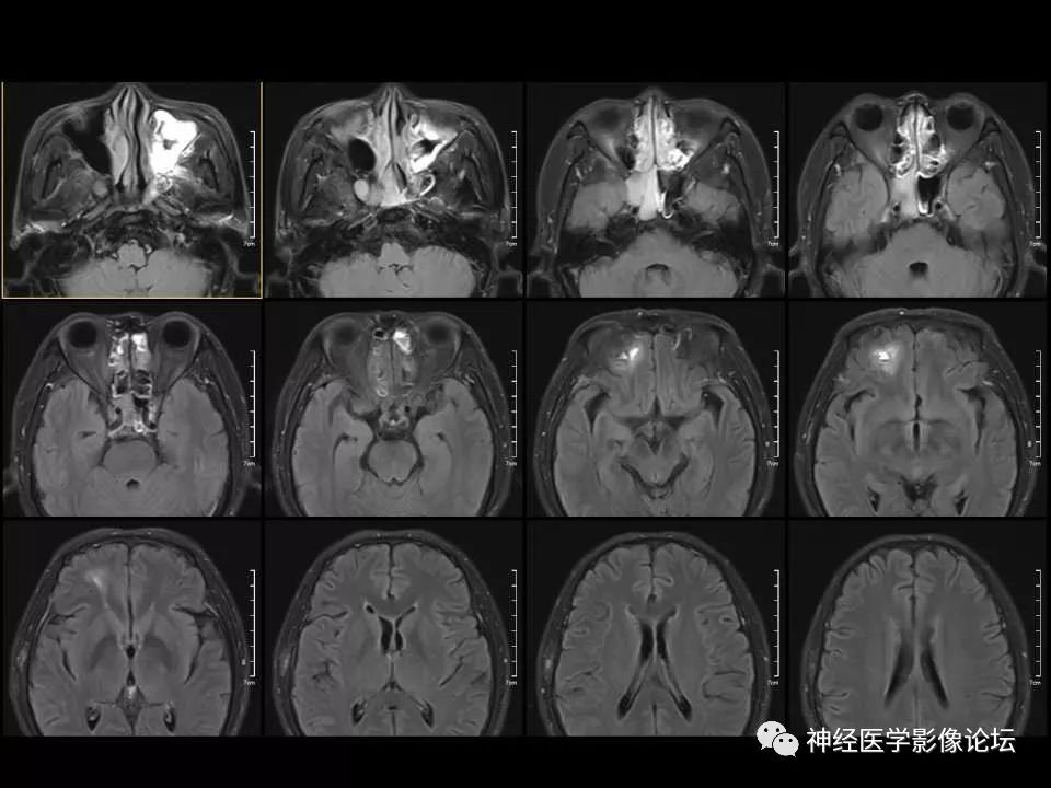 【病例】右额叶脑挫裂伤一例MR及CT