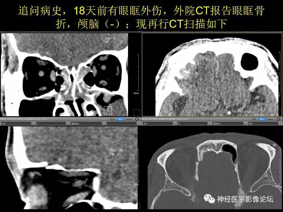 【病例】右额叶脑挫裂伤一例MR及CT