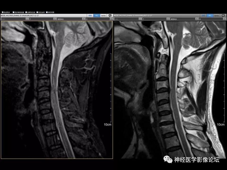 【病例】右额叶脑挫裂伤一例MR及CT