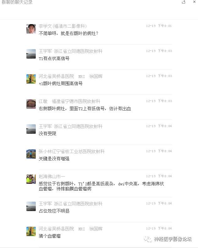 【病例】右额叶脑挫裂伤一例MR及CT