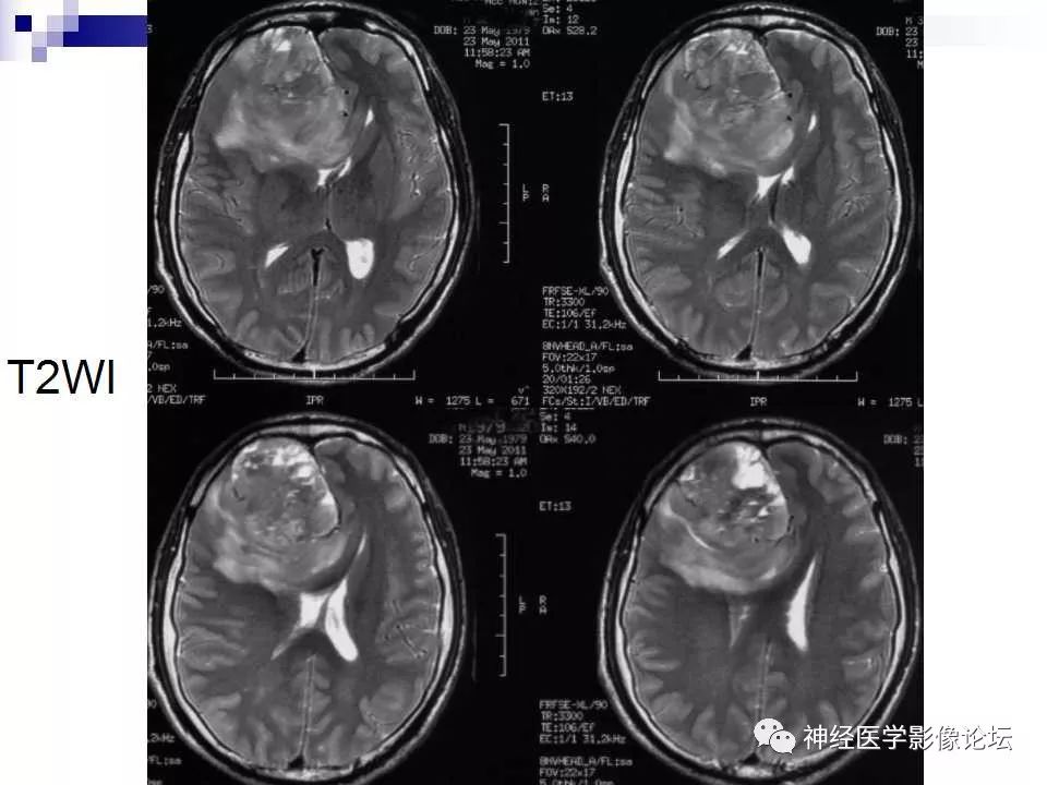 【病例】脑室外中枢神经细胞瘤1例MR