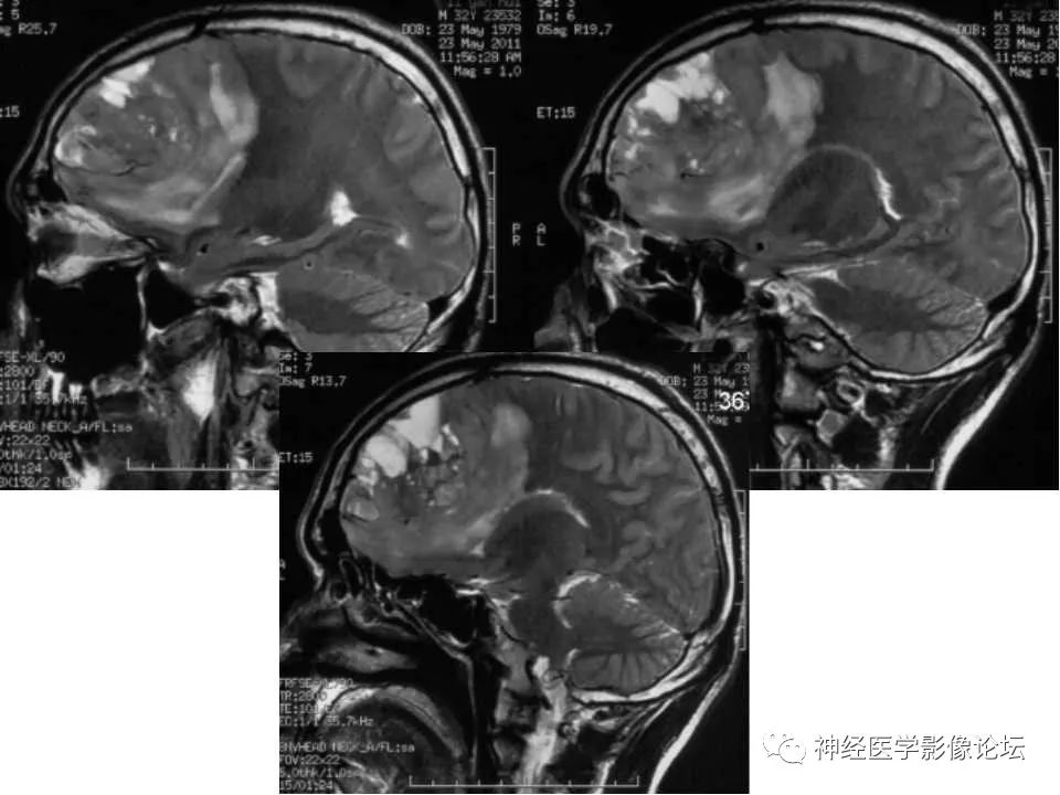 【病例】脑室外中枢神经细胞瘤1例MR