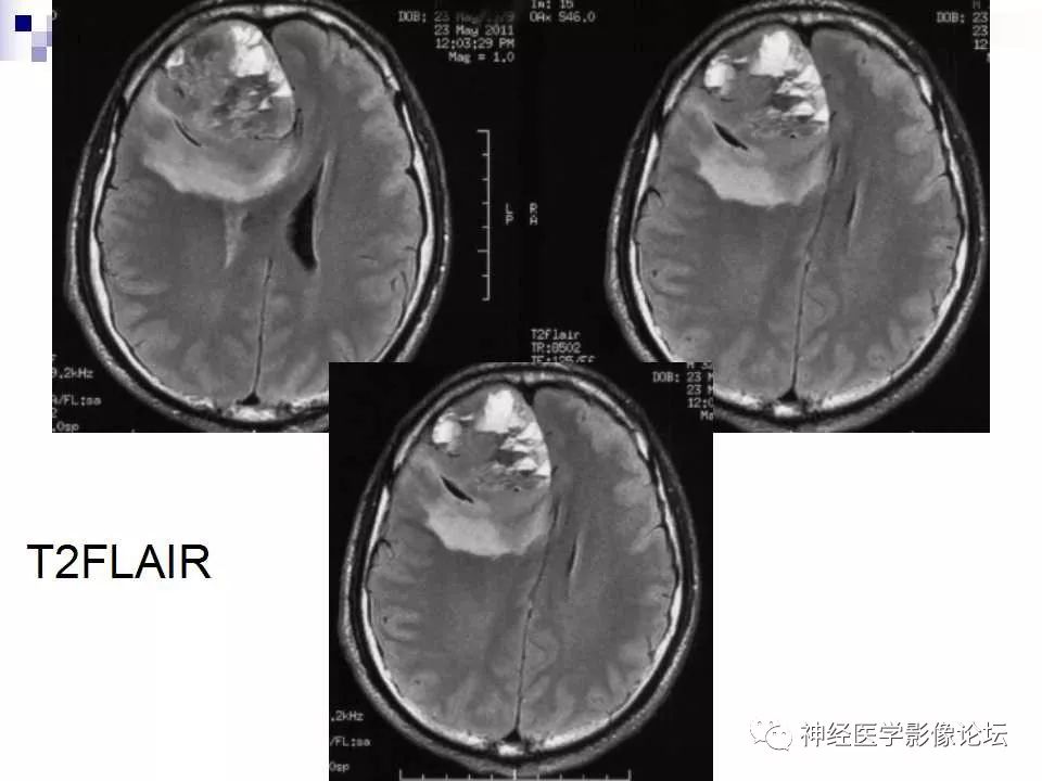 【病例】脑室外中枢神经细胞瘤1例MR