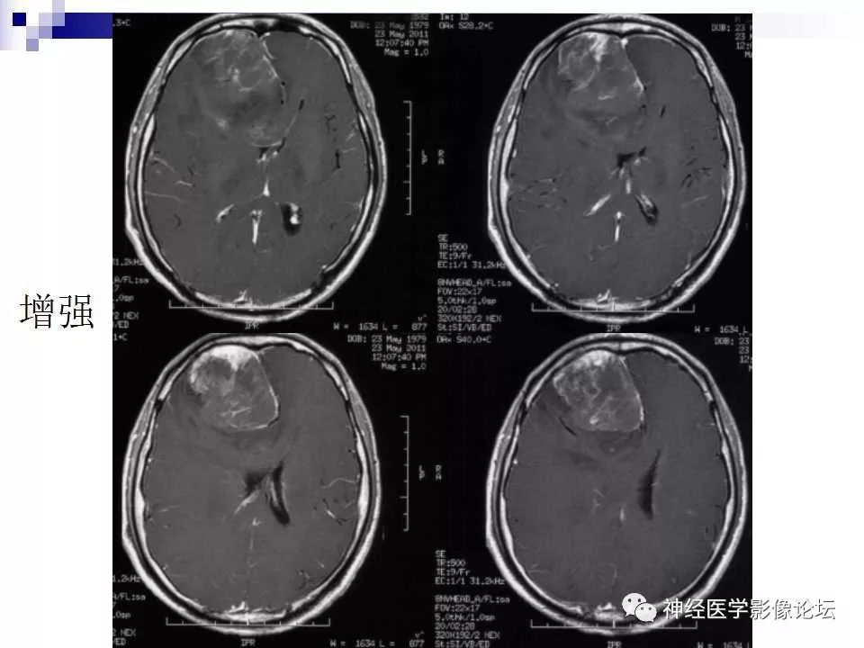 【病例】脑室外中枢神经细胞瘤1例MR