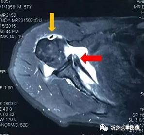 【病例】肩关节损伤疾病10例MR分析