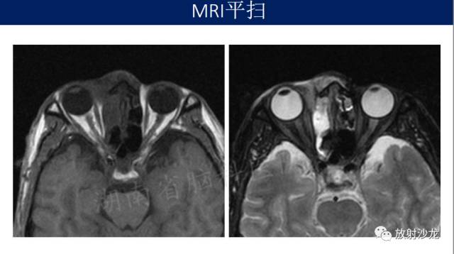 【病例】眼眶淋巴瘤1例MR影像表现