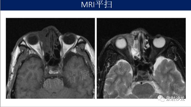 【病例】眼眶淋巴瘤1例MR影像表现