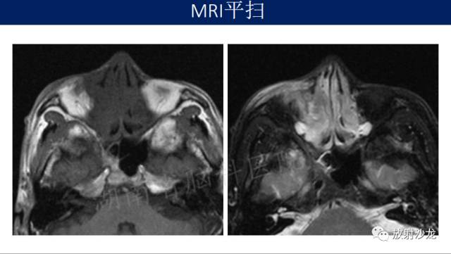 【病例】眼眶淋巴瘤1例MR影像表现