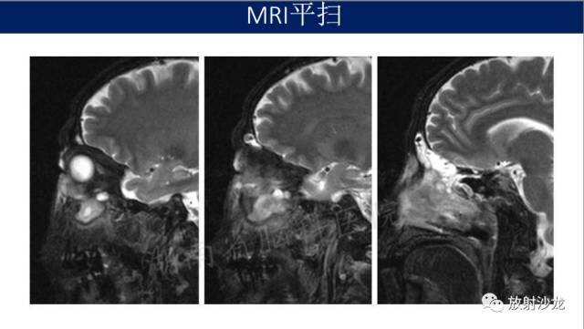 【病例】眼眶淋巴瘤1例MR影像表现