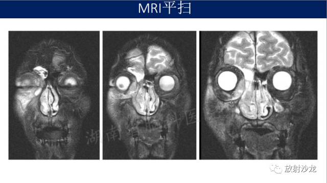 【病例】眼眶淋巴瘤1例MR影像表现