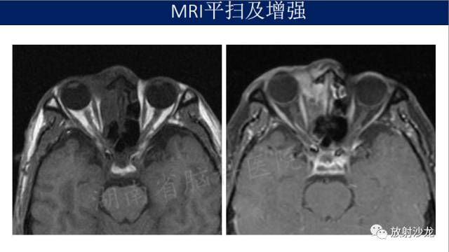 【病例】眼眶淋巴瘤1例MR影像表现