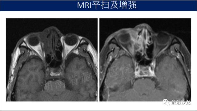 【病例】眼眶淋巴瘤1例MR影像表现