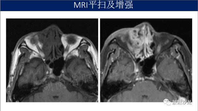 【病例】眼眶淋巴瘤1例MR影像表现