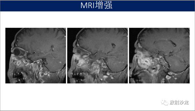 【病例】眼眶淋巴瘤1例MR影像表现