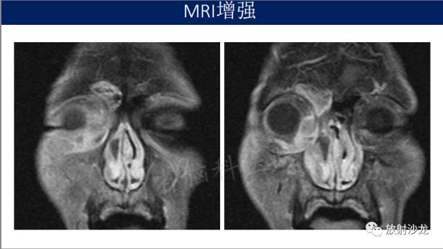 【病例】眼眶淋巴瘤1例MR影像表现