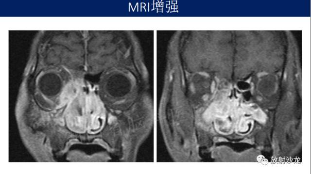 【病例】眼眶淋巴瘤1例MR影像表现