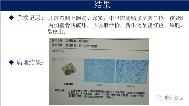 【病例】眼眶淋巴瘤1例MR影像表现