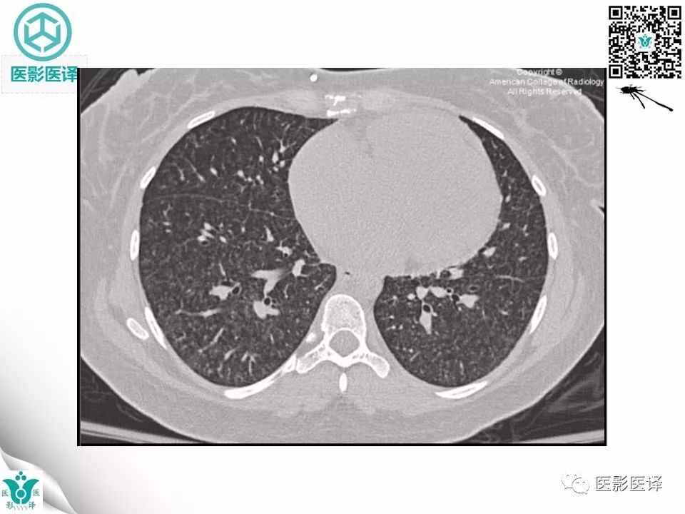 【病例】肺毛细血管瘤病1例CT影像表现