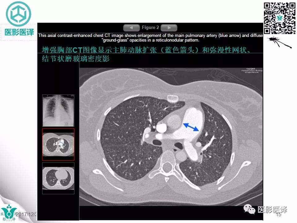 【病例】肺毛细血管瘤病1例CT影像表现
