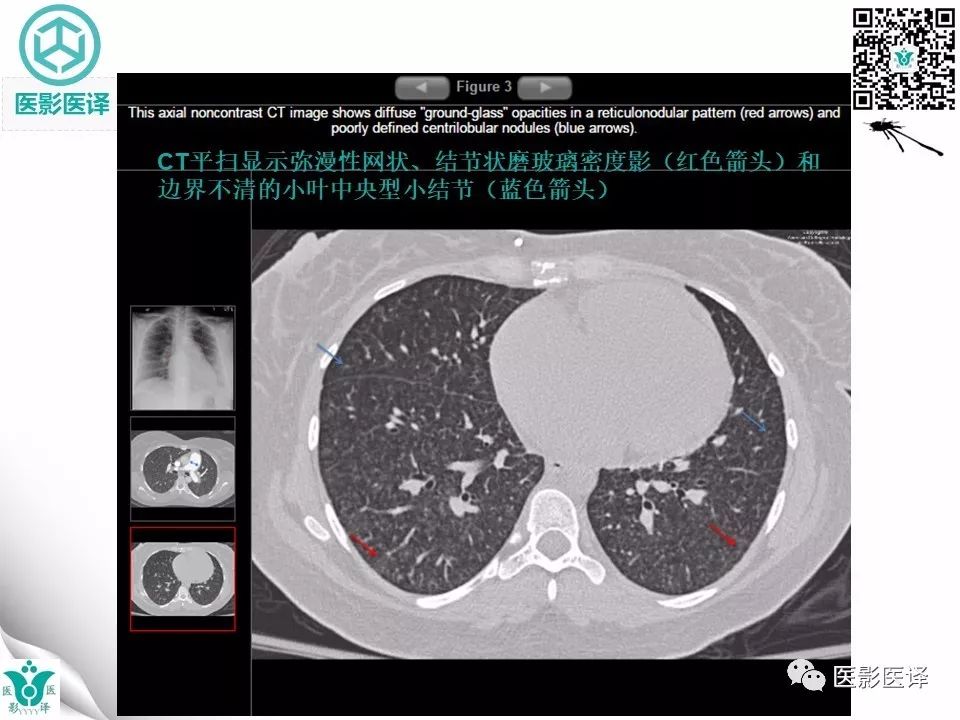 【病例】肺毛细血管瘤病1例CT影像表现