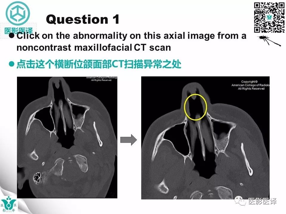 【病例】鼻中隔穿孔1例CT影像表现