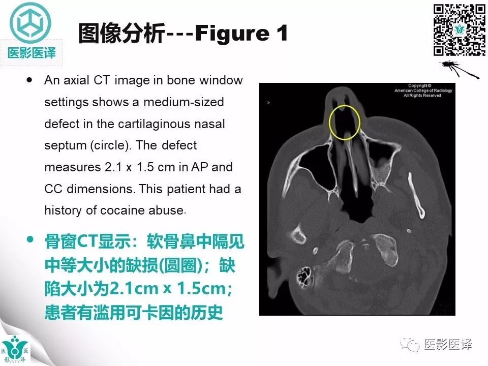 【病例】鼻中隔穿孔1例CT影像表现