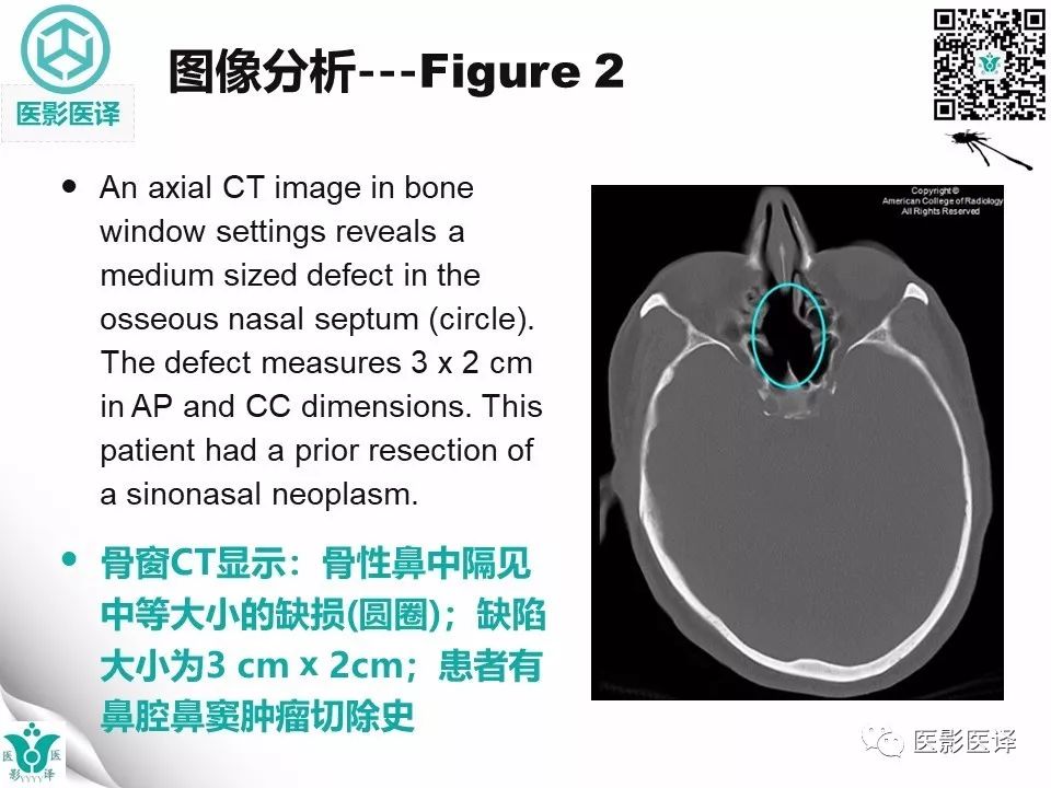 【病例】鼻中隔穿孔1例CT影像表现