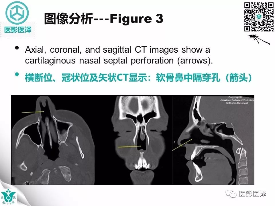 【病例】鼻中隔穿孔1例CT影像表现