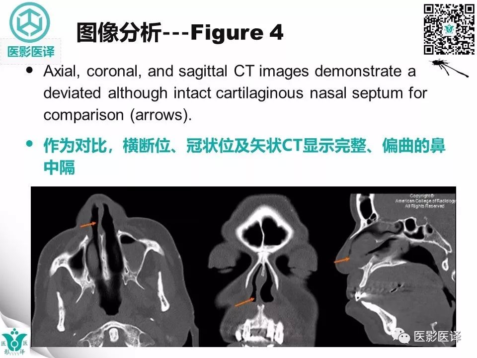【病例】鼻中隔穿孔1例CT影像表现