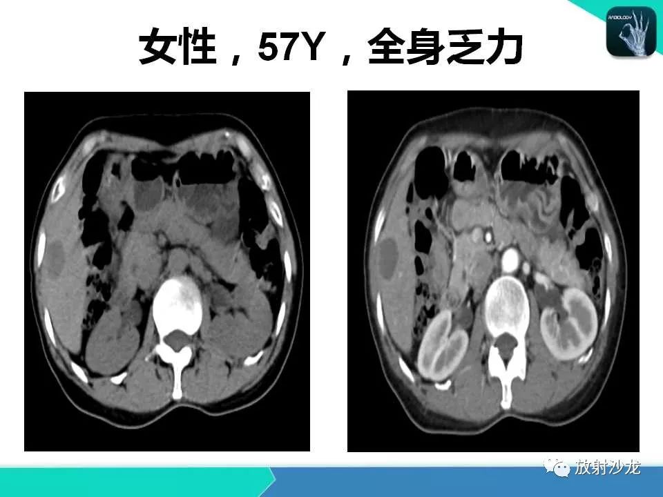 【PPT】肝脏孤立性坏死结节的CT、MRI诊断及鉴别诊断