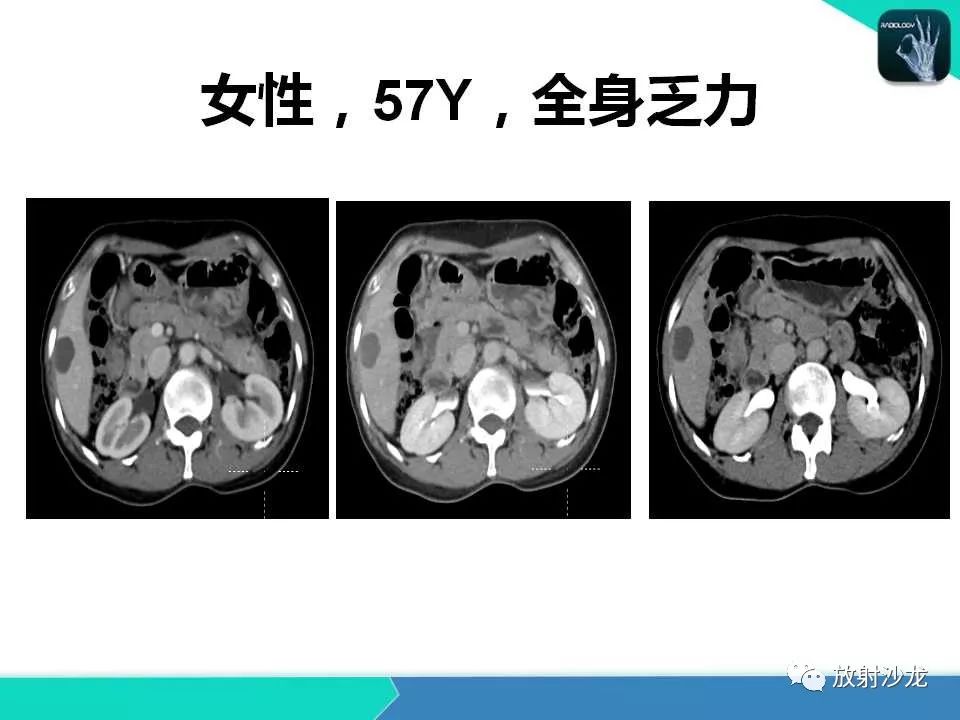 【PPT】肝脏孤立性坏死结节的CT、MRI诊断及鉴别诊断