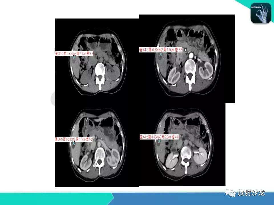 【PPT】肝脏孤立性坏死结节的CT、MRI诊断及鉴别诊断