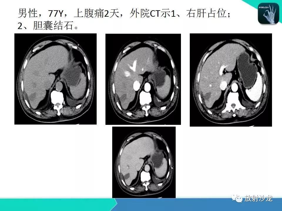 【PPT】肝脏孤立性坏死结节的CT、MRI诊断及鉴别诊断