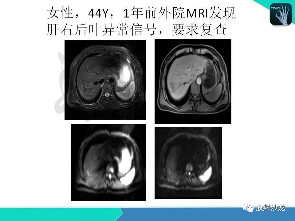 【PPT】肝脏孤立性坏死结节的CT、MRI诊断及鉴别诊断