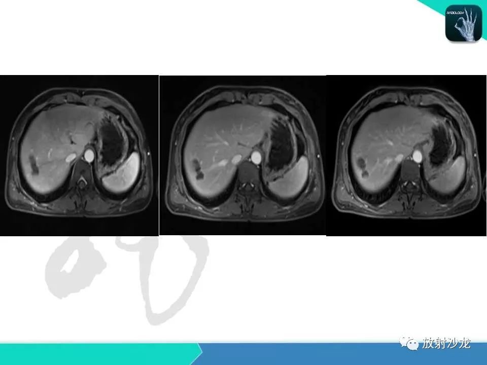 【PPT】肝脏孤立性坏死结节的CT、MRI诊断及鉴别诊断