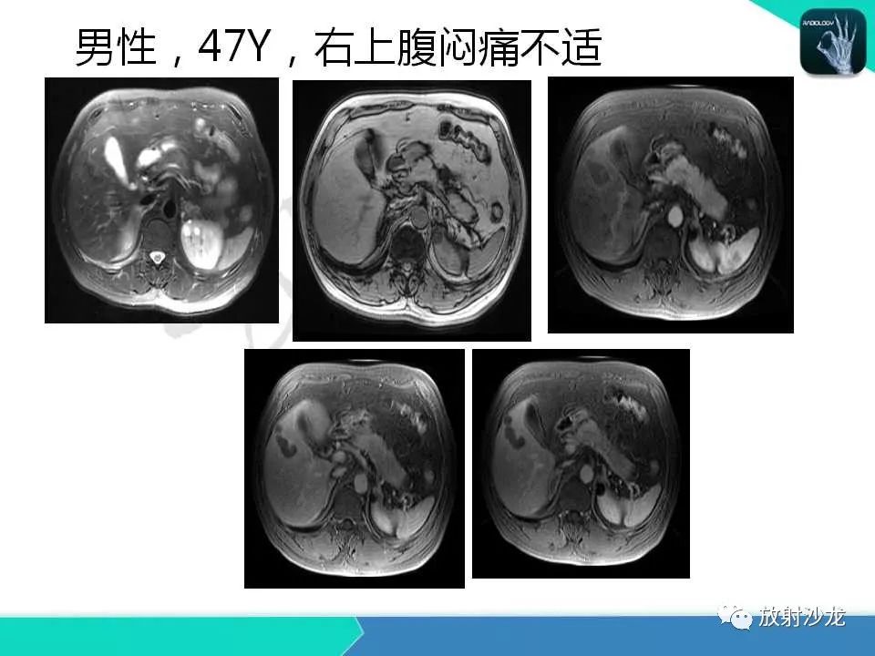 【PPT】肝脏孤立性坏死结节的CT、MRI诊断及鉴别诊断