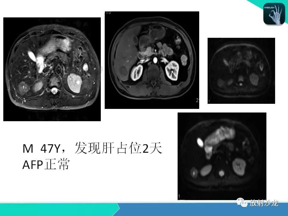 【PPT】肝脏孤立性坏死结节的CT、MRI诊断及鉴别诊断