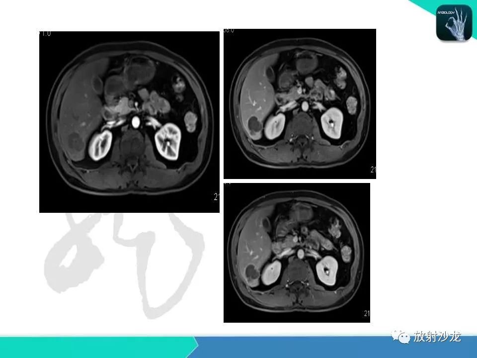 【PPT】肝脏孤立性坏死结节的CT、MRI诊断及鉴别诊断