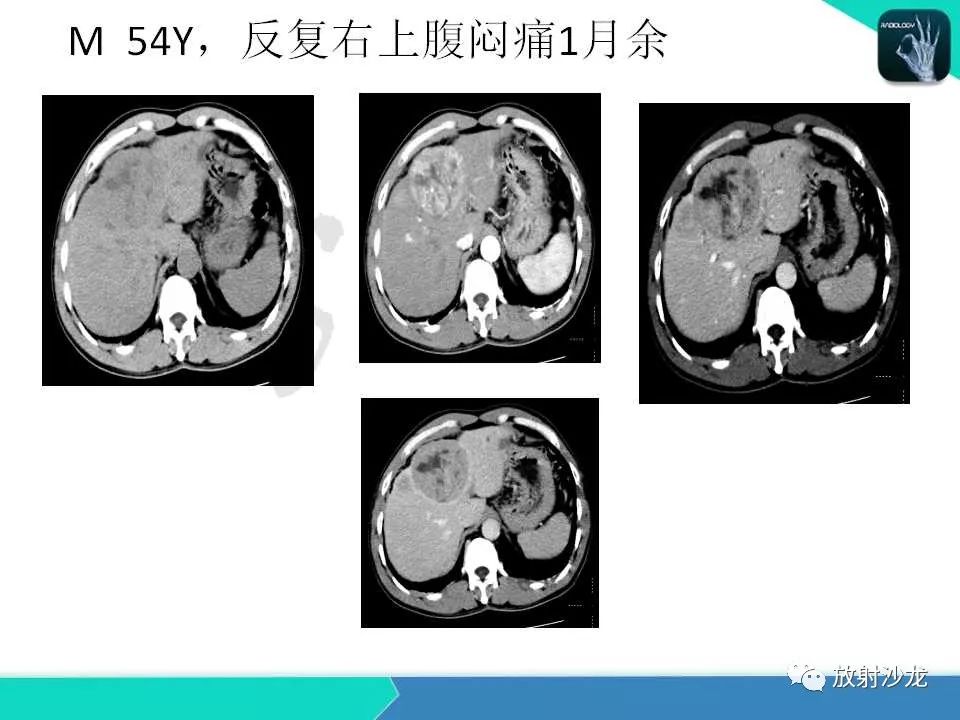 【PPT】肝脏孤立性坏死结节的CT、MRI诊断及鉴别诊断