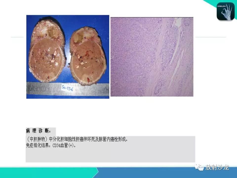 【PPT】肝脏孤立性坏死结节的CT、MRI诊断及鉴别诊断