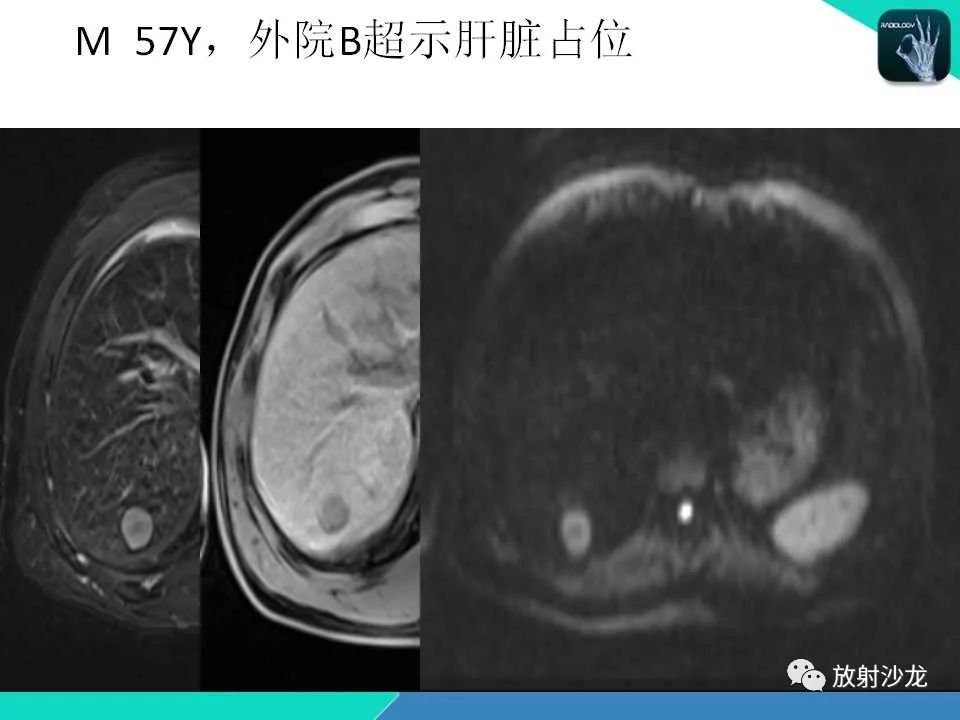【PPT】肝脏孤立性坏死结节的CT、MRI诊断及鉴别诊断