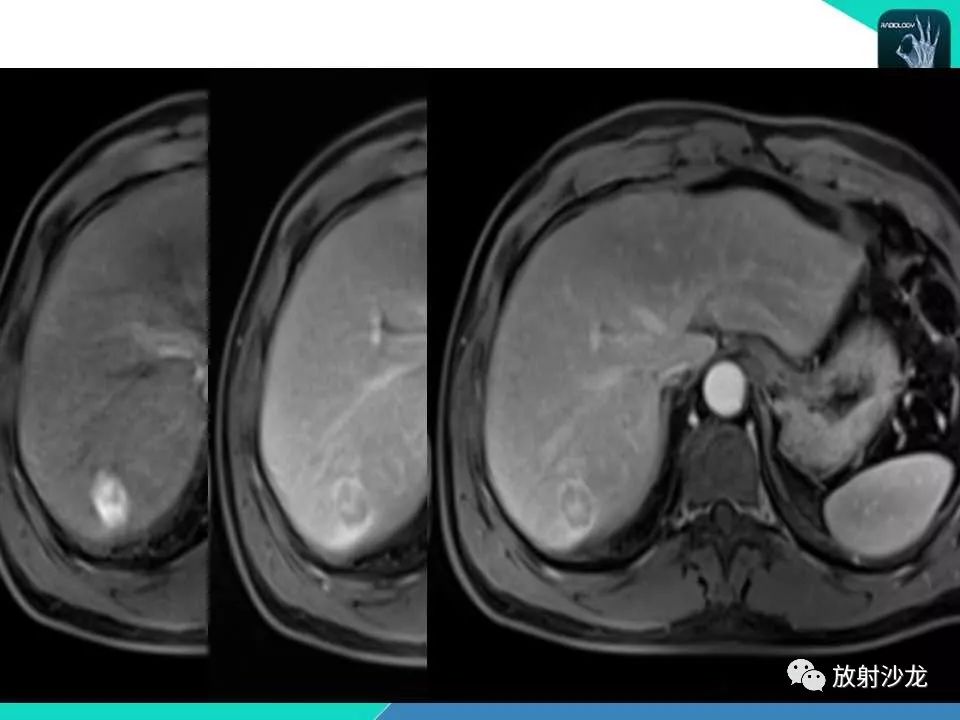 【PPT】肝脏孤立性坏死结节的CT、MRI诊断及鉴别诊断