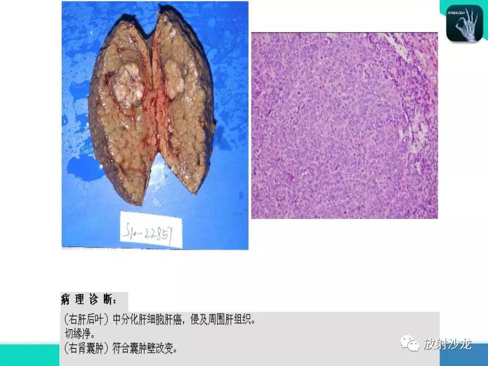 【PPT】肝脏孤立性坏死结节的CT、MRI诊断及鉴别诊断