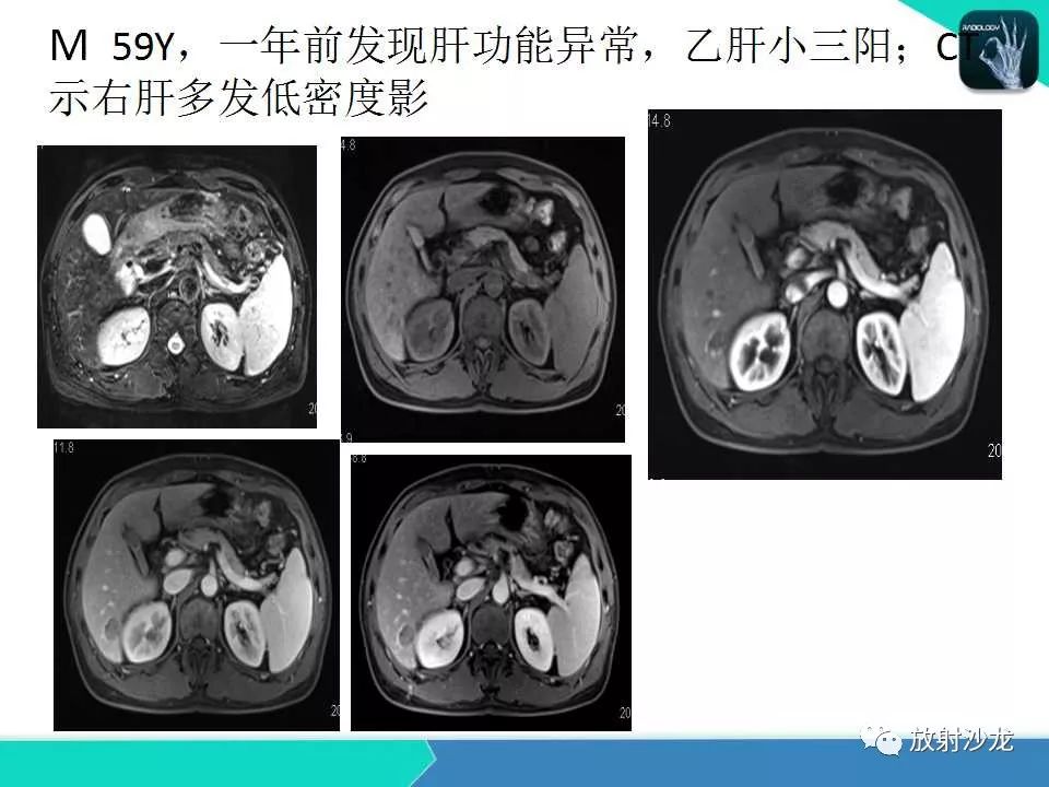 【PPT】肝脏孤立性坏死结节的CT、MRI诊断及鉴别诊断