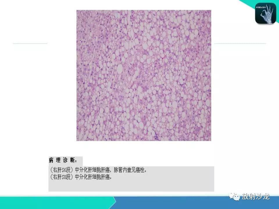 【PPT】肝脏孤立性坏死结节的CT、MRI诊断及鉴别诊断