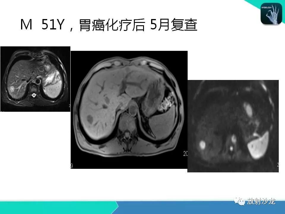 【PPT】肝脏孤立性坏死结节的CT、MRI诊断及鉴别诊断